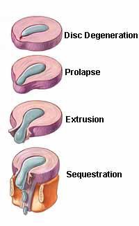 Slipped Disc